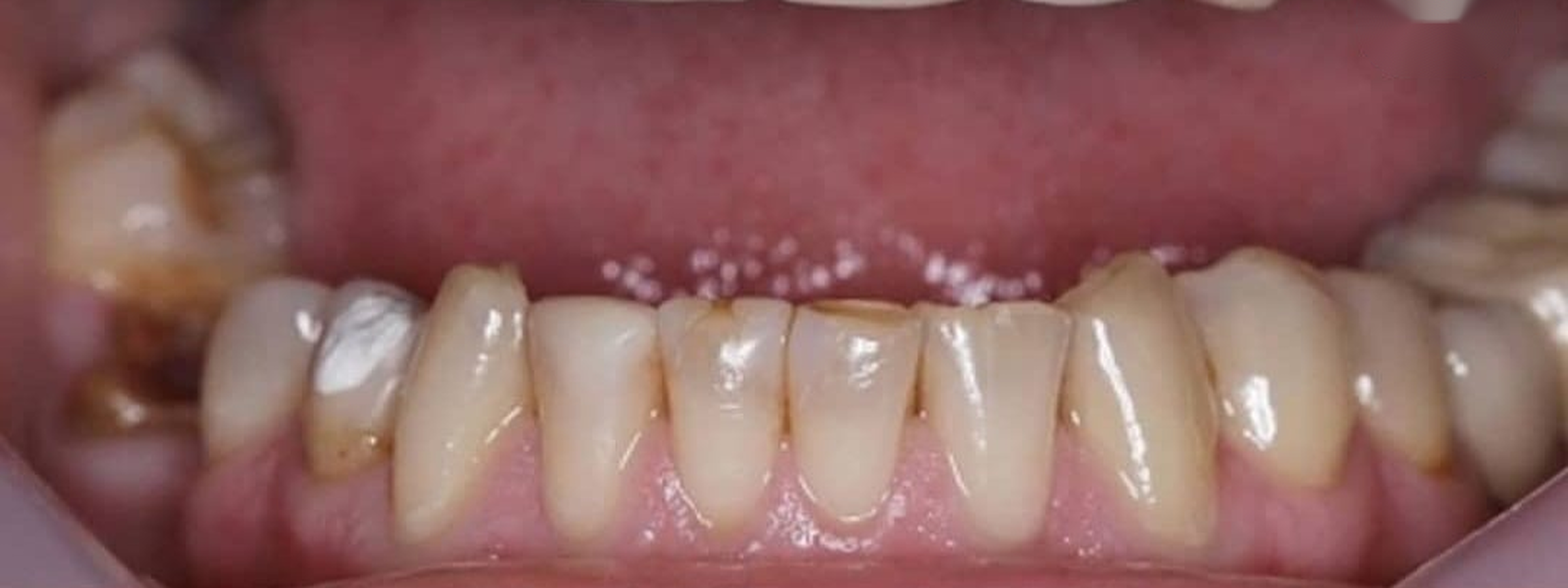Crowns treatment result before treatment
